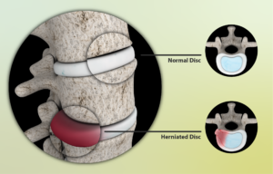 herniated disc